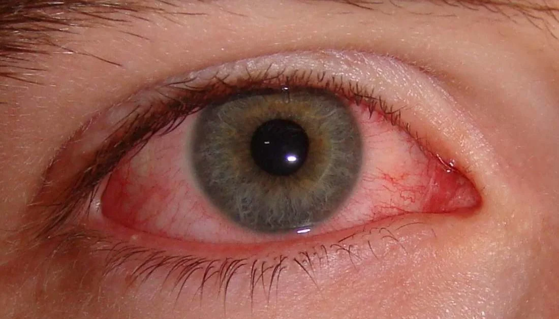 Viral eye infection (conjunctivitis)